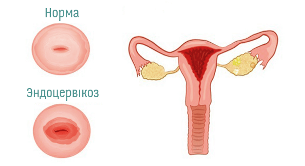 Передракові захворювання та рак жіночих статевих органів
